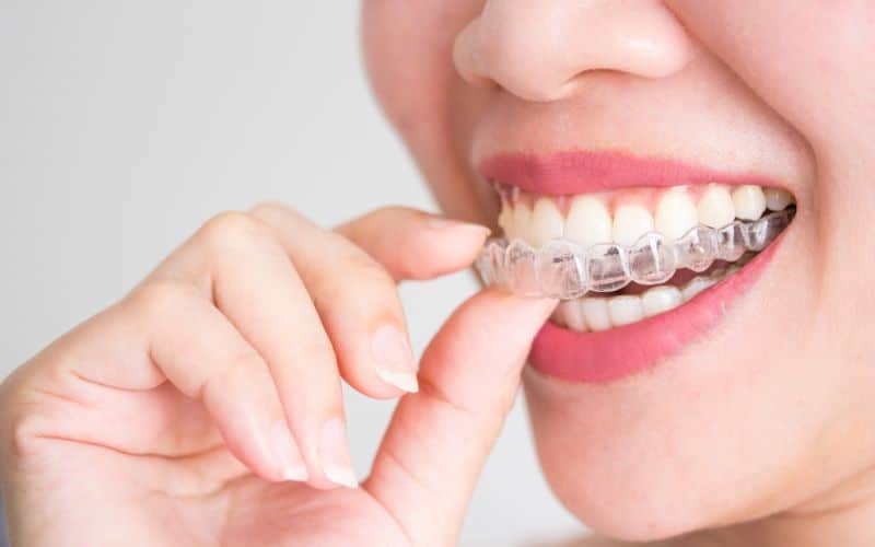 יישור שיניים ללא גשר - שיטת אינויזליין