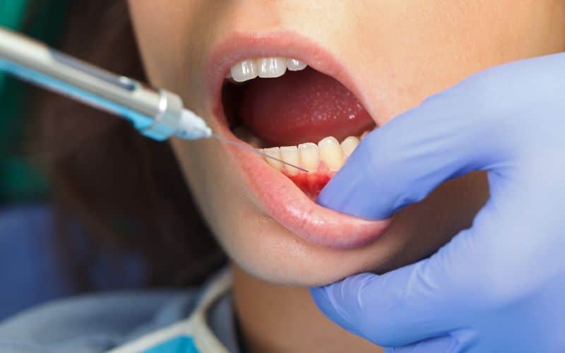 המצבים העיקריים בהם טיפולי שיניים ייעשו בהרדמה מלאה