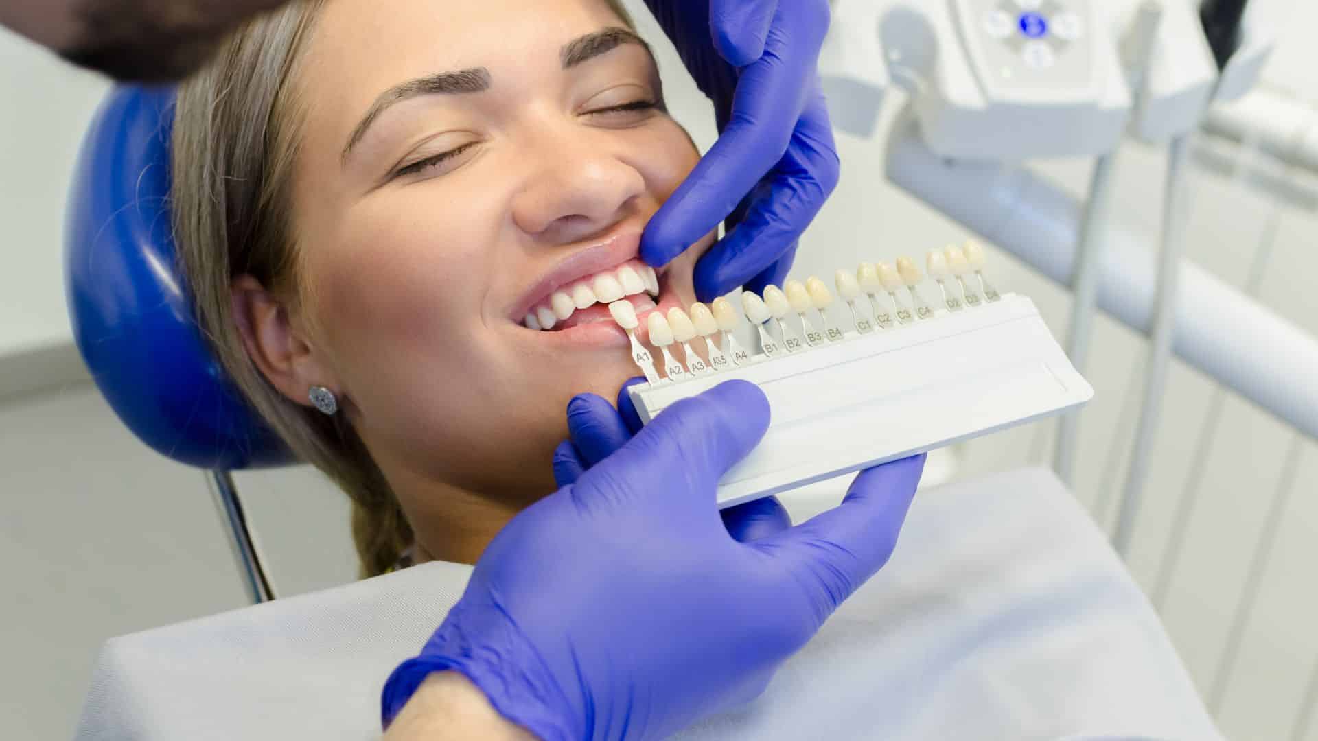 הלבנת שיניים 
