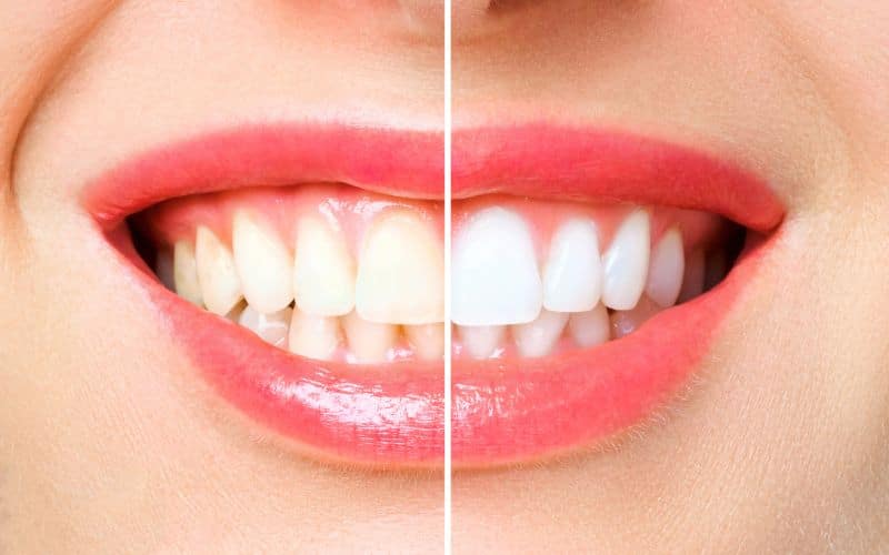 הלבנת שיניים טבעית